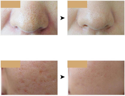 Máscara de Fototerapia LED 7-en-1